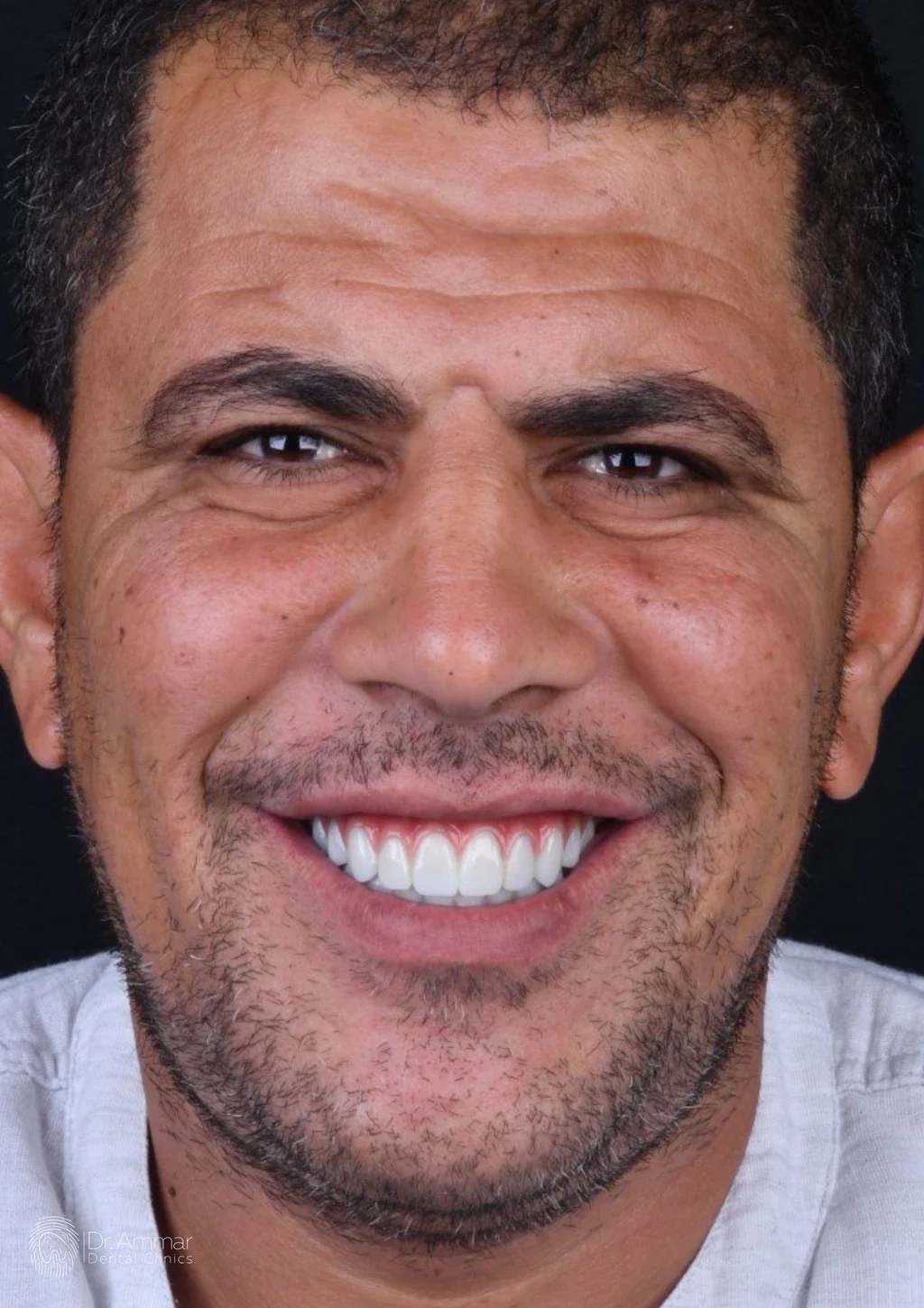 زراعة الفك بالكامل — بعد