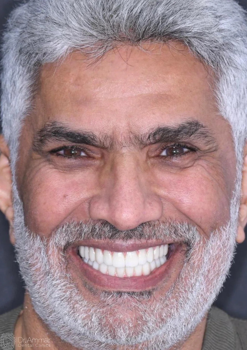زراعة الفك بالكامل — بعد