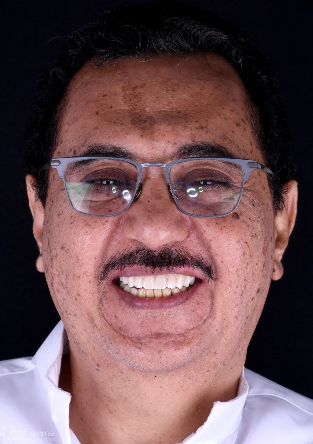 زراعة الفك بالكامل — بعد