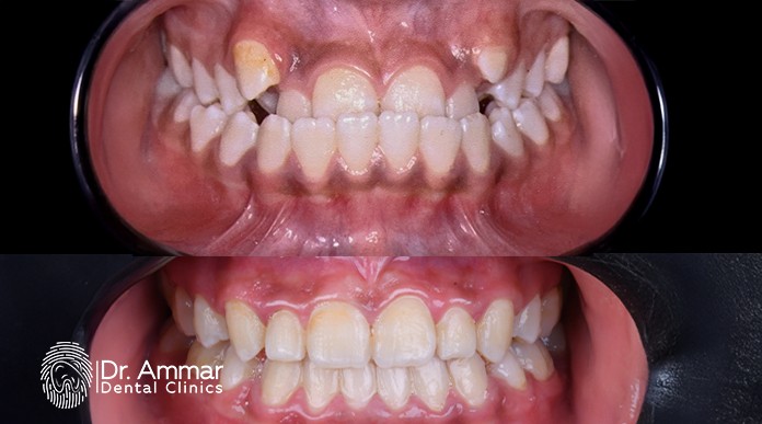 Dental Braces