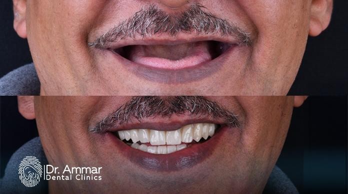 Jawbone Grafting for Dental Implants