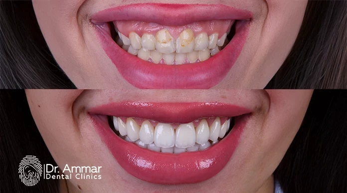 What is dental veneer