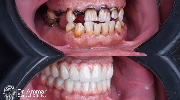 Immediate dental implants in Riyadh