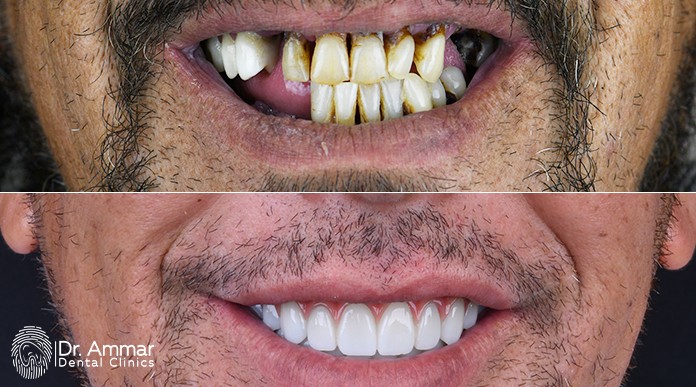 Dental Implant Cost in Riyadh