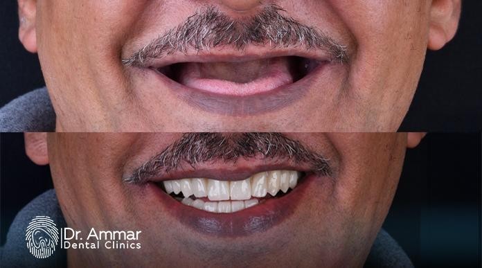 Dental implant experiences in Riyadh