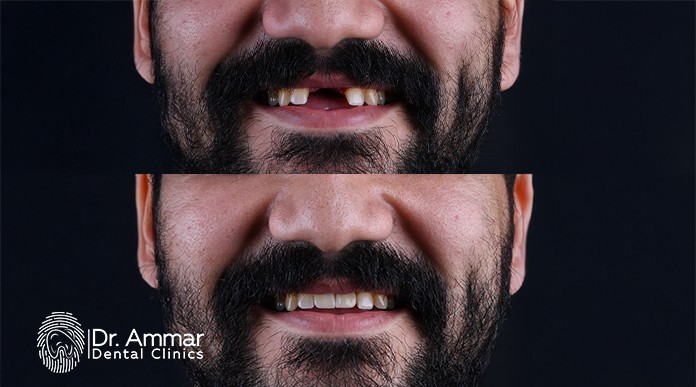 Are Dental Implants Painful?