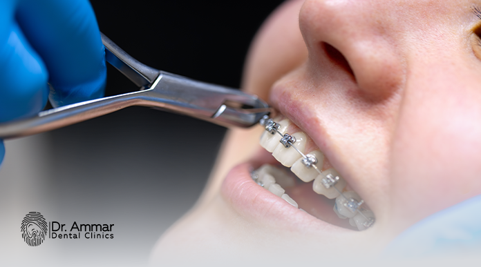 Types of braces and their prices
