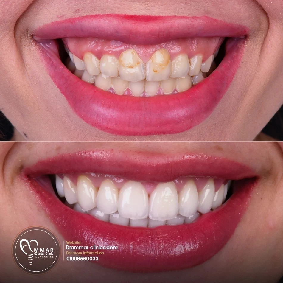 Before and after cases of veneers