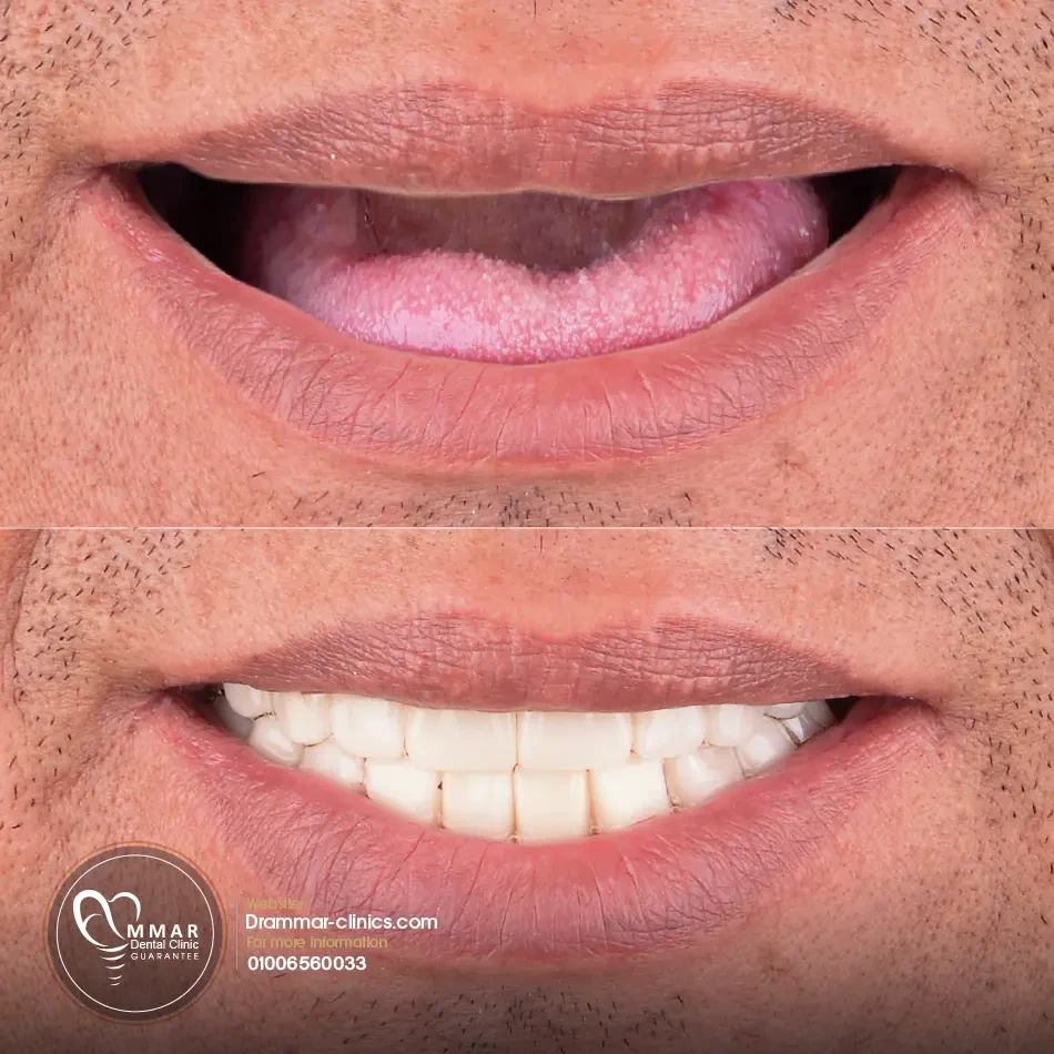 Jaw implant surgery steps