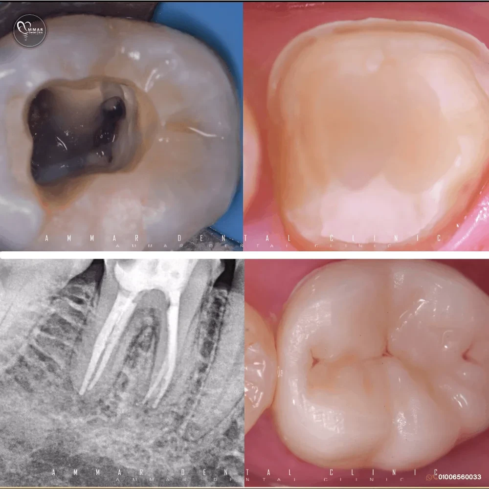 Best root canal treatment center in Cairo