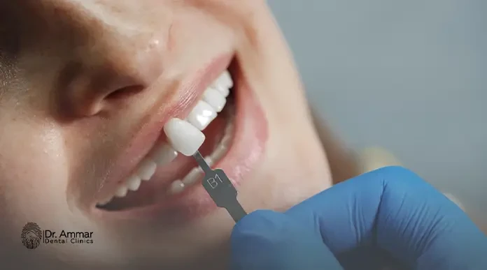 Dental veneers without drilling