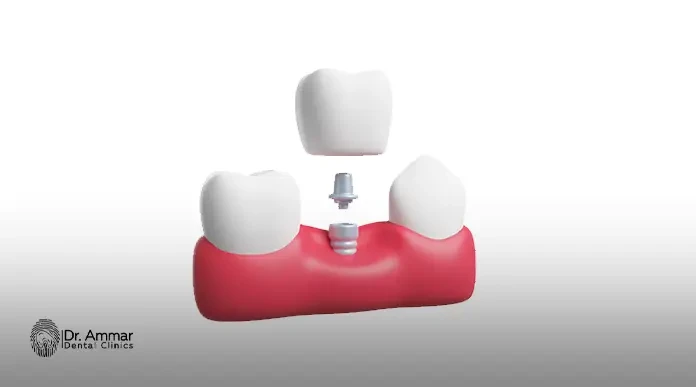 Price of installing a single removable tooth