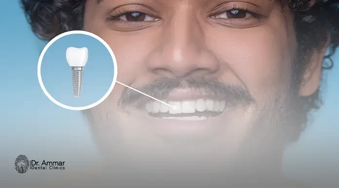 Cost of replacing a missing tooth