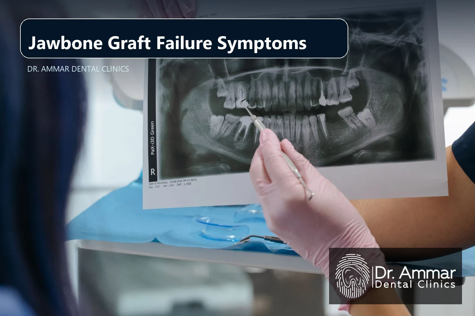 Symptoms of Jawbone Graft Failure