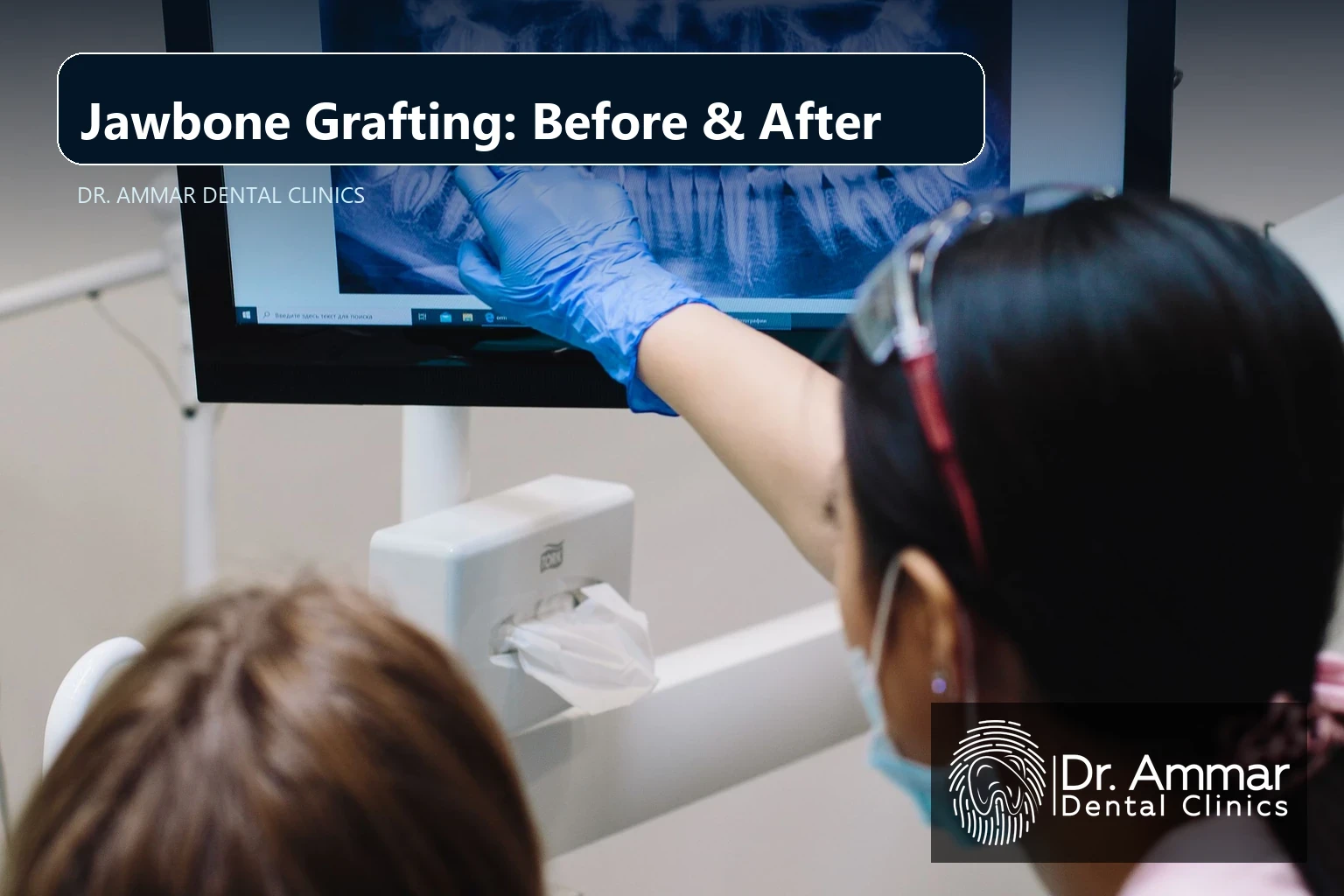 Jawbone Grafting Before and After