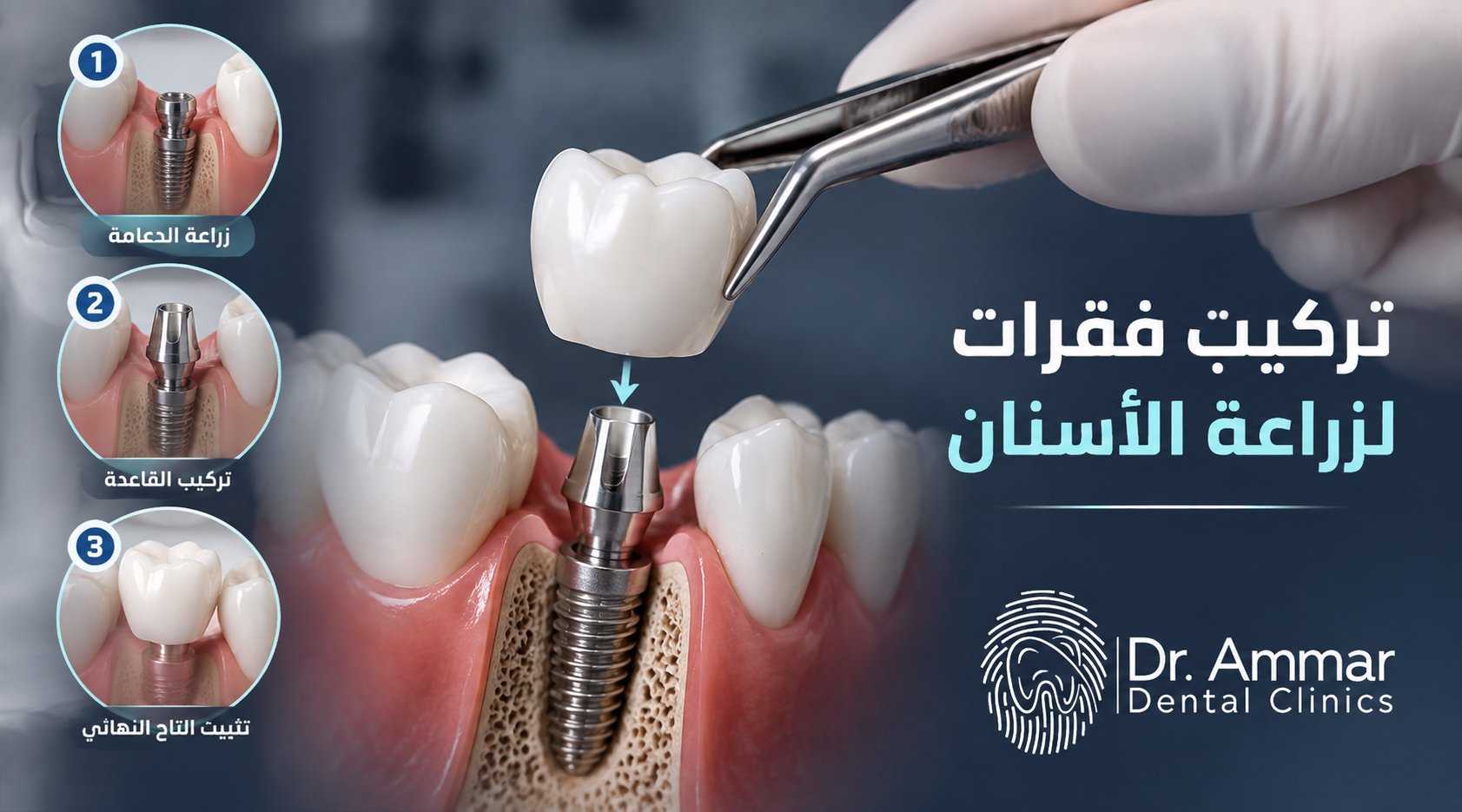 Placement of dental implant components