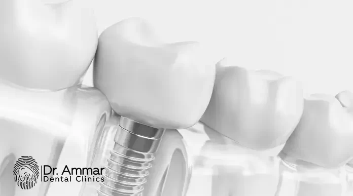 Best Dental Implant Centers in Egypt