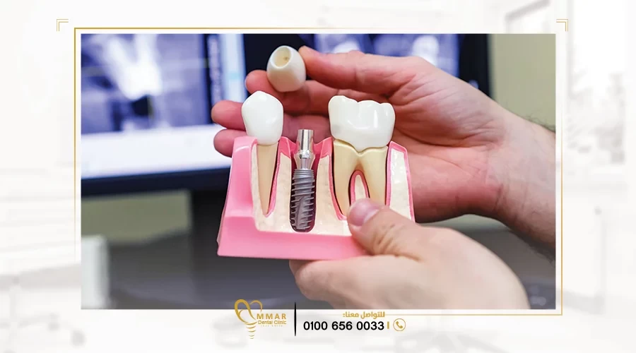 Boneless dental implants