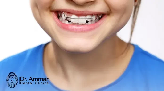 Types of Orthodontic Braces