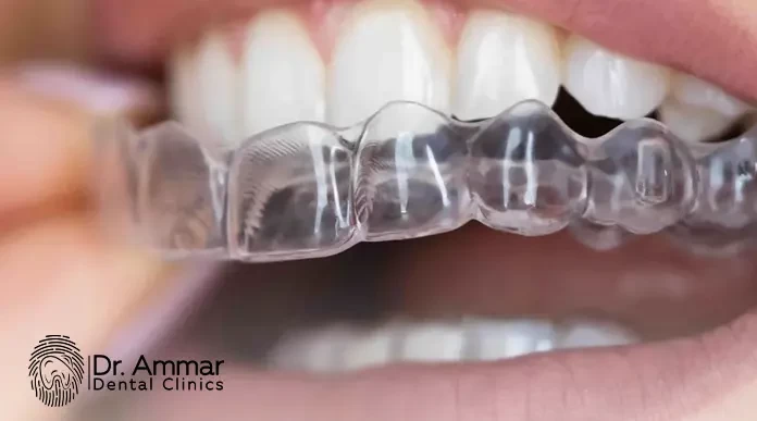 Clear Aligners