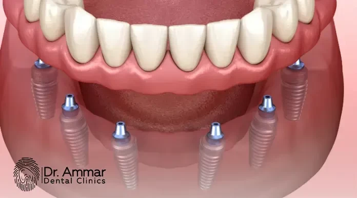 How Much Do Fixed Dental Crowns Cost in Egypt