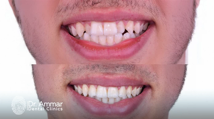 Adult Braces