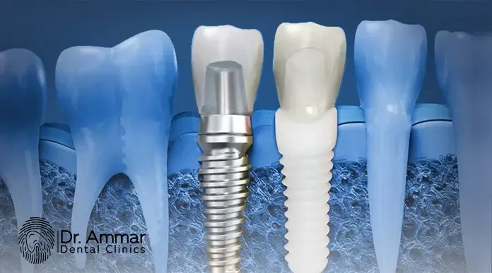 Zirconia Dental Crown Prices in Egypt