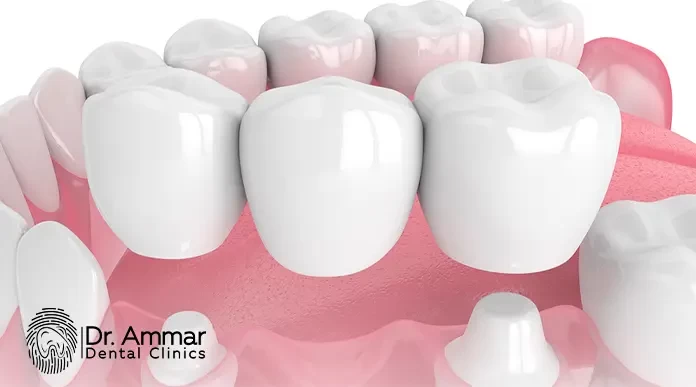 Dental Bridge Installation