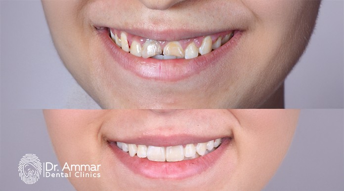 Cosmetic Dental Fillings in Egypt