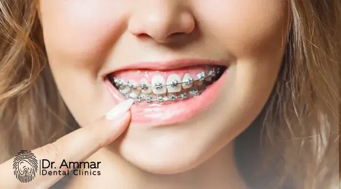 Teeth Braces Price