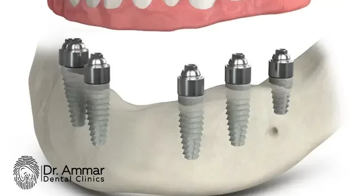 Dental Implant Cost in Egypt