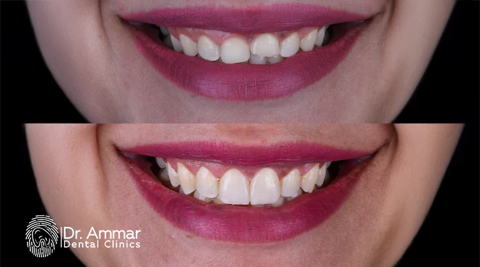 Cosmetic Filling for Front Teeth