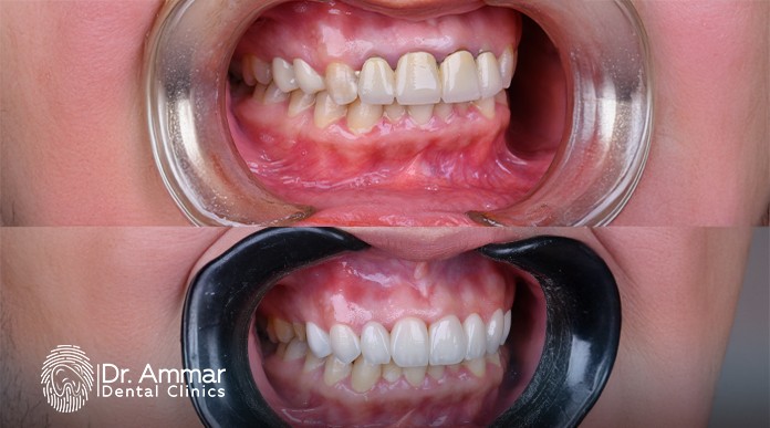 Fast-acting gingivitis treatment