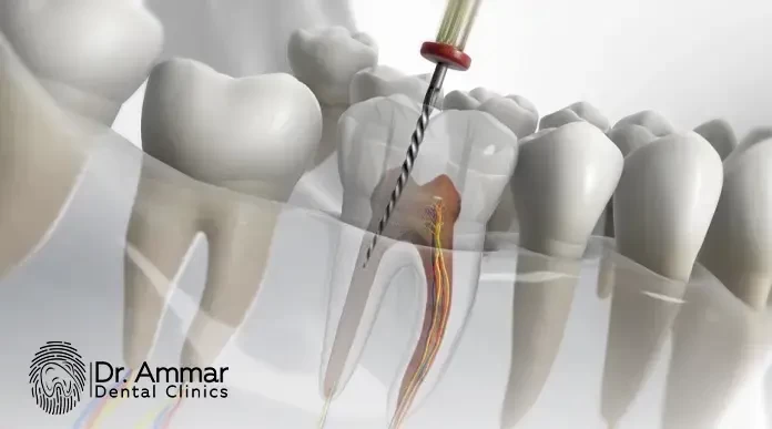 How Much Does Root Canal Treatment Cost