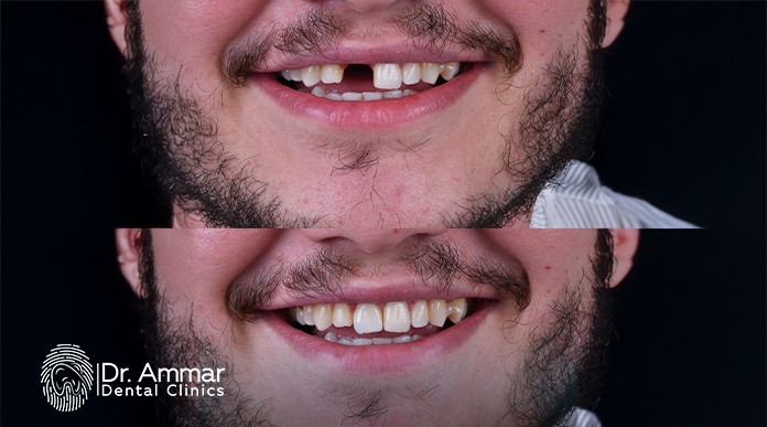 Dental Implant Problems