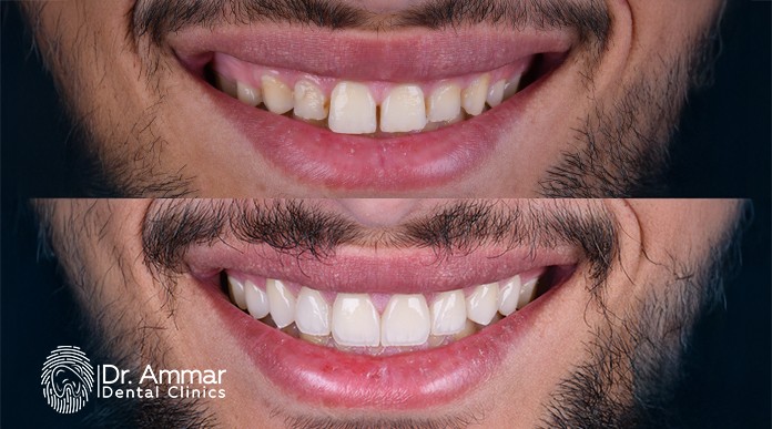Cost of Veneers