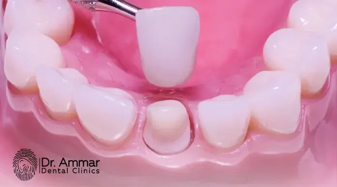 Fixed Tooth Replacement