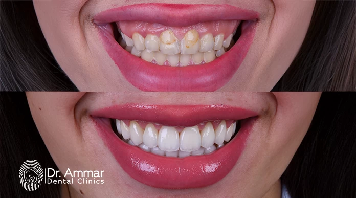 Veneers Before and After