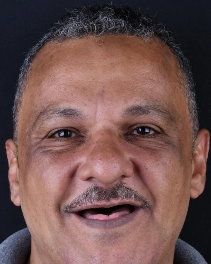 زراعة الأسنان — قبل