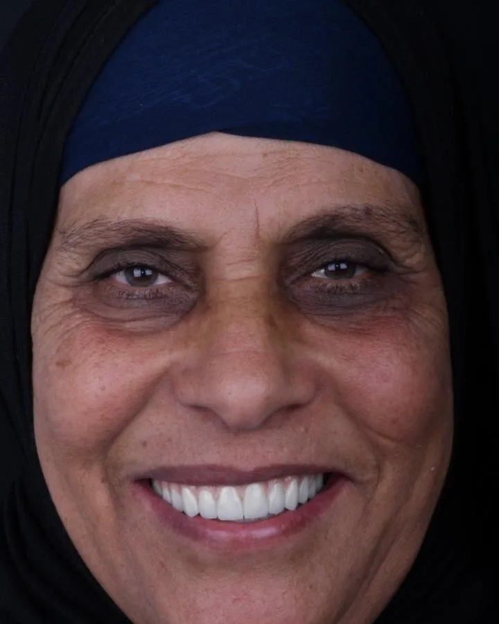 زراعة الأسنان — بعد