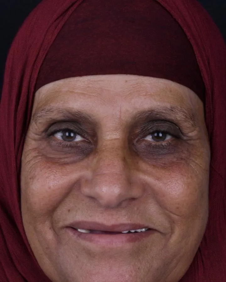 زراعة الأسنان — قبل