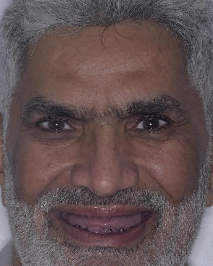 زراعة الأسنان — قبل