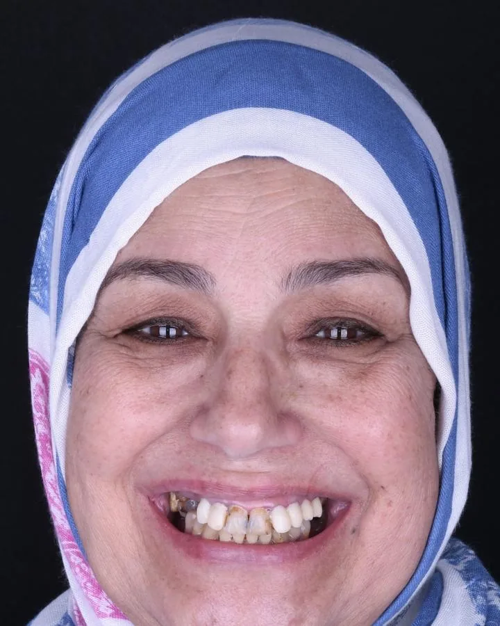 زراعة الأسنان — قبل
